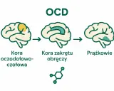 Ilustracja pokazuje, co to jest OCD: zmiany w korze mózgowej, w tym kora oczodołowo-czołowa i kora zakrętu obręczy, oraz prążkowia.